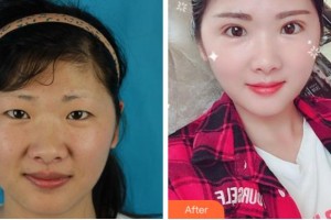 溫州和平整形醫(yī)院周健整形價格表附切開雙眼皮案例展示
