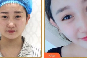 溫州和平整形醫(yī)院郭光燁整形價格表附眼部綜合案例展示