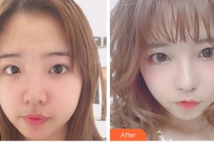 溫州和平整形醫(yī)院劉照文整形價格表附眼部綜合案例展示