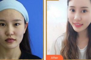 溫州和平整形醫(yī)院梁贊姜整形價格表附眼部綜合案例展示