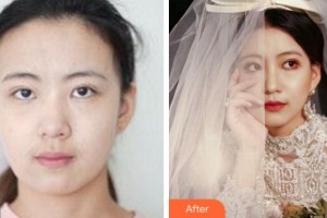 溫州藝星醫(yī)學美容醫(yī)院曾文尚整形價格表附熱瑪吉案例展示