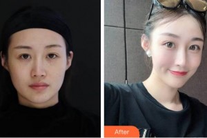 溫州藝星醫(yī)學美容醫(yī)院李久恒整形價格表附埋線提升案例展示