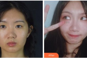 溫州藝星醫(yī)學美容醫(yī)院金在元整形價格表附切開雙眼皮案例展示