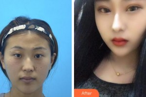 溫州藝星醫(yī)學美容醫(yī)院張至德整形價格表附切開雙眼皮案例展示