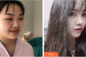 溫州藝星醫(yī)學美容醫(yī)院新倉辛一整形價格表附術(shù)前眼皮松弛案例展示