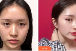 溫州藝星醫(yī)學美容醫(yī)院林穎新整形價格表附眼部綜合案例展示