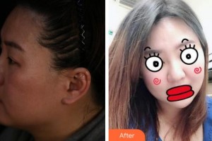 溫州雅美姬整形美容醫(yī)院白晉整形價格表附埋線提升案例展示