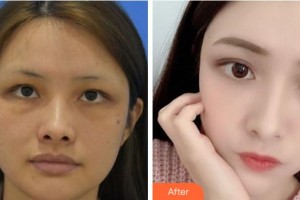 溫州藝星醫(yī)學美容醫(yī)院譚立文整形價格表附埋線提升案例展示