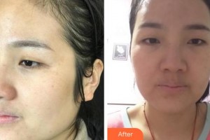 溫州解放軍118醫(yī)院整形科程靜文整形價(jià)格表附激光祛斑案例展示