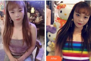 溫州解放軍118醫(yī)院整形科鄒先彪整形價(jià)格表附埋線提升案例展示