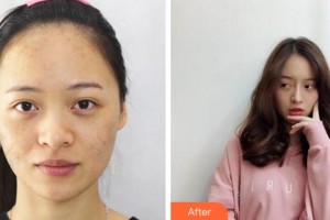 溫州解放軍118醫(yī)院整形科呂瑾整形價(jià)格表附激光祛斑案例展示