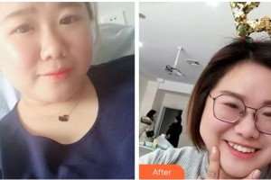 溫州藝星醫(yī)學(xué)美容醫(yī)院韋克新整形價(jià)格表附牙齒隱形矯正案例展示