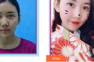 溫州醫(yī)學(xué)院附屬第一醫(yī)院整形外科鄭君達(dá)整形價(jià)格表附射頻緊膚案例展示