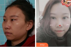 溫州芘麗芙美容醫(yī)院梁富榮整形價(jià)格表附切開雙眼皮案例展示