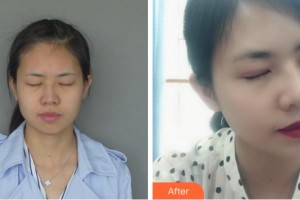 溫州芘麗芙美容醫(yī)院江昌鈞整形價(jià)格表附切開雙眼皮案例展示