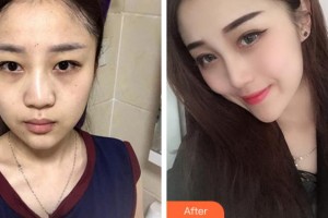 溫州醫(yī)學(xué)院附屬第一醫(yī)院整形外科潘臻文整形價(jià)格表附鼻部綜合案例展示