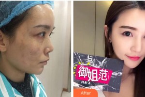 溫州和平整形醫(yī)院李張玲整形價(jià)格表附激光祛斑案例展示