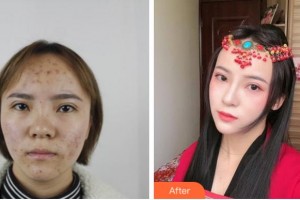 溫州友好醫(yī)院整形美容中心尹建祥整形價(jià)格表附鼻部綜合案例展示