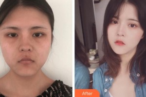 溫州雅美姬整形美容醫(yī)院張東舜整形價(jià)格表附埋線提升案例展示