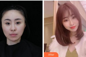 溫州東華醫(yī)院醫(yī)療美容科李營整形價(jià)格表附膠原蛋白除皺案例展示