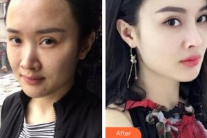 溫州解放軍118醫(yī)院整形科陳世棟整形價(jià)格表附熱瑪吉案例展示