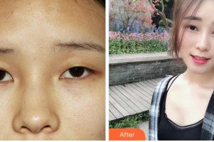 溫州藝美整形美容醫(yī)院季豪整形價(jià)格表附埋線雙眼皮案例展示