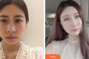 溫州韓星醫(yī)療美容門(mén)診部陳美香整形價(jià)格表附眼部綜合案例展示