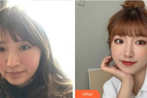 溫州解放軍118醫(yī)院整形科江婷整形價(jià)格表附激光祛斑案例展示