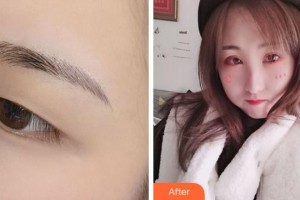 溫州藝星醫(yī)學(xué)美容醫(yī)院馬秀芬整形價(jià)格表附切開(kāi)雙眼皮案例展示