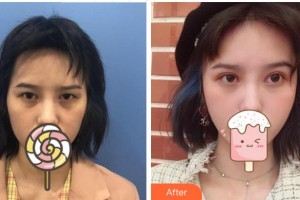 溫州東華醫(yī)院醫(yī)療美容科張群整形價(jià)格表附切開(kāi)雙眼皮案例展示