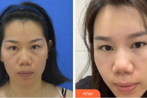 溫州東華醫(yī)院醫(yī)療美容科馬昌樺整形價(jià)格表附激光去眼袋案例展示