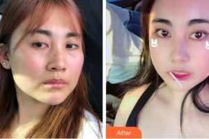 溫州東華醫(yī)院醫(yī)療美容科張鑌整形價(jià)格表附眼部綜合案例展示