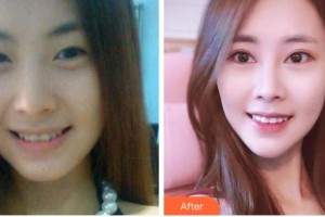 溫州東華醫(yī)院醫(yī)療美容科孫艷華整形價(jià)格表附定點(diǎn)雙眼皮案例展示