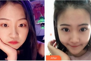 溫州星范醫(yī)學(xué)美容門(mén)診部應(yīng)天詳整形價(jià)格表附切開(kāi)雙眼皮案例展示