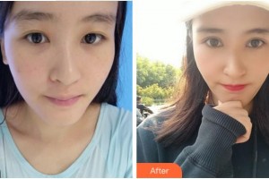 溫州芙萊拉醫(yī)療美容醫(yī)院但漢乾整形價(jià)格表附切開(kāi)雙眼皮案例展示