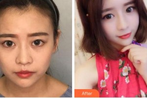 溫州芙萊拉醫(yī)療美容醫(yī)院毛志翔整形價(jià)格表附熱瑪吉案例展示