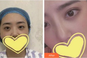 溫州藝星醫(yī)學(xué)美容醫(yī)院柴軍整形價(jià)格表附眼部綜合案例展示