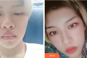 溫州佑康和平整形醫(yī)院陳炳偉整形價(jià)格表附切開(kāi)雙眼皮案例展示