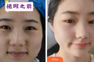 溫州上雅醫(yī)學(xué)美容門(mén)診部吳慧明整形價(jià)格表附激光祛斑案例展示