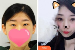 溫州藝星醫(yī)學(xué)美容醫(yī)院黃樂(lè)整形價(jià)格表附切開(kāi)雙眼皮案例展示