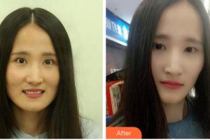 溫州王曉峰口腔醫(yī)院王曉峰整形價(jià)格表附牙齒陶瓷矯正案例展示