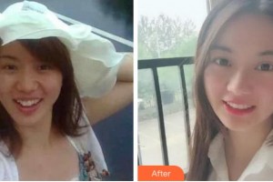 溫州王曉峰口腔醫(yī)院孫相宇整形價(jià)格表附金屬托槽矯正案例展示