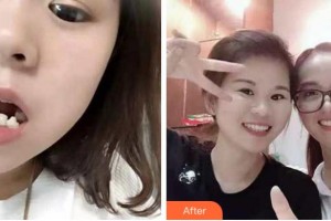 溫州市中西醫(yī)結(jié)合醫(yī)院醫(yī)學(xué)美容中心柯友輝整形價格表附牙齒陶瓷矯正案例展示