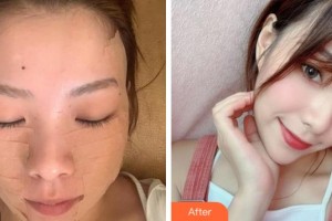 溫州伯思立醫(yī)院醫(yī)療美容科鄒仙娥整形價格表附埋線提升案例展示