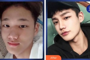 溫州伯思立醫(yī)院醫(yī)療美容科周亞超整形價格表附切開雙眼皮案例展示