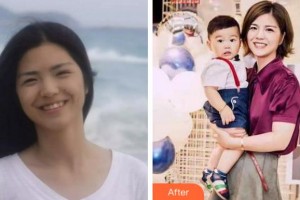 溫州醫(yī)科大學(xué)附屬口腔學(xué)院麻健豐整形價格表附牙齒隱形矯正案例展示