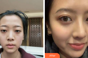 深圳晨曦醫(yī)療美容醫(yī)院吉梅斯整形價格表附半肋鼻部手術(shù)案例展示