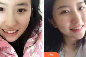 深圳博美醫(yī)療美容門診部高凱整形價格表附隱適美矯正案例展示