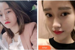 溫州醫(yī)科大學(xué)附屬口腔學(xué)院劉勁松整形價格表附牙齒隱形矯正案例展示