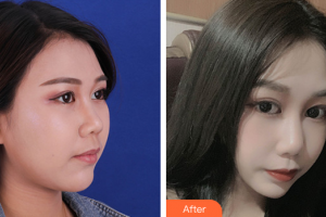 深圳美客華美醫(yī)療美容門診部整形價格表附雙下巴吸脂案例展示